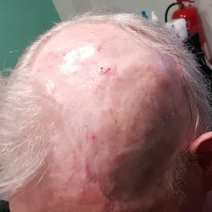 Hair loss Manchester