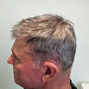 Hairpieces for hair loss in Stockport